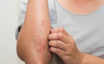 Picazón y brotes en la piel: cómo controlar la Dermatitis Atópica