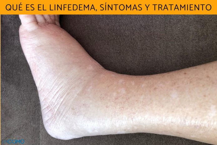 que_es_el_linfedema_sintomas_y_tratamiento_53729_orig